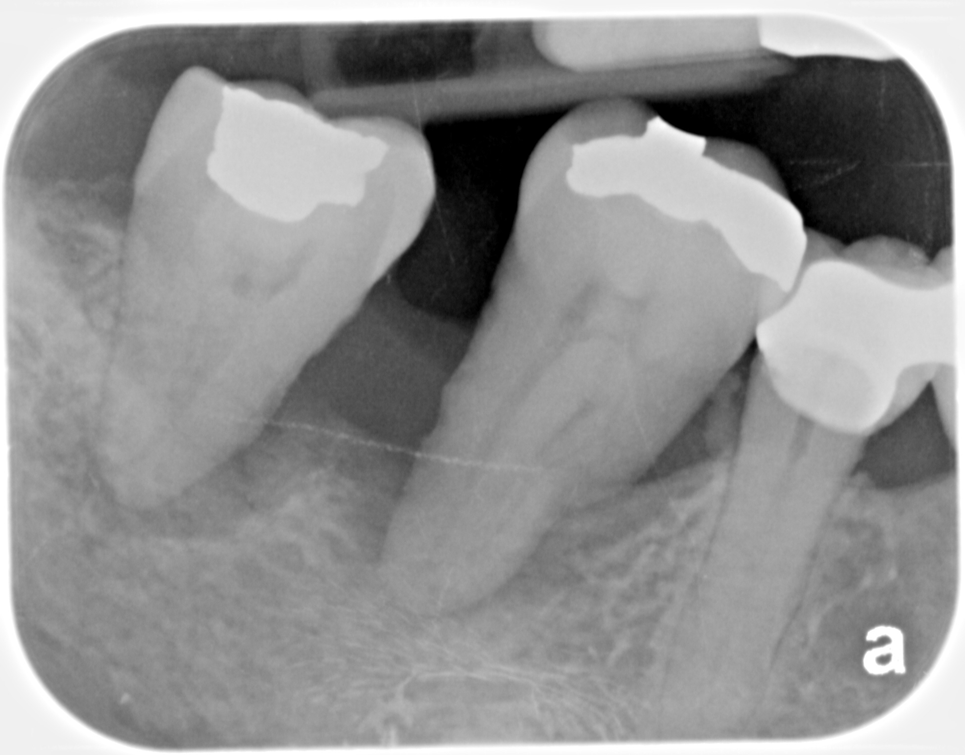 Bone growth after LANAP, before Louisville Cosmetic and Laser dentistry