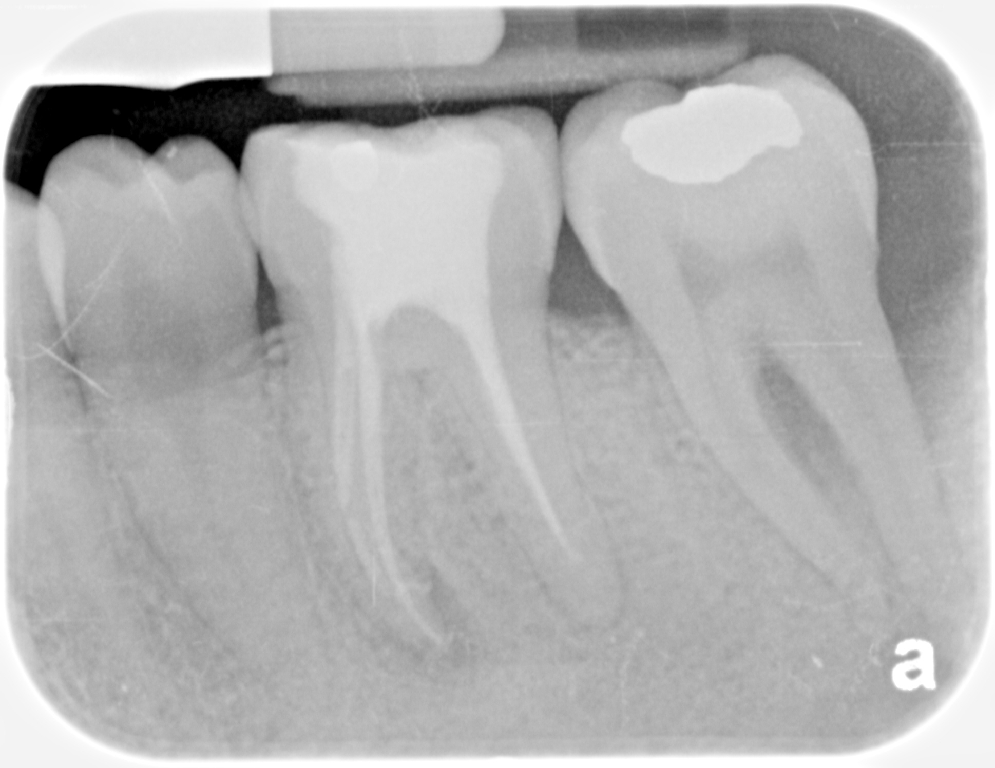 Bone in furcation after LANAP, bone growth, Louisville Laser and Cosmetic Dentistry