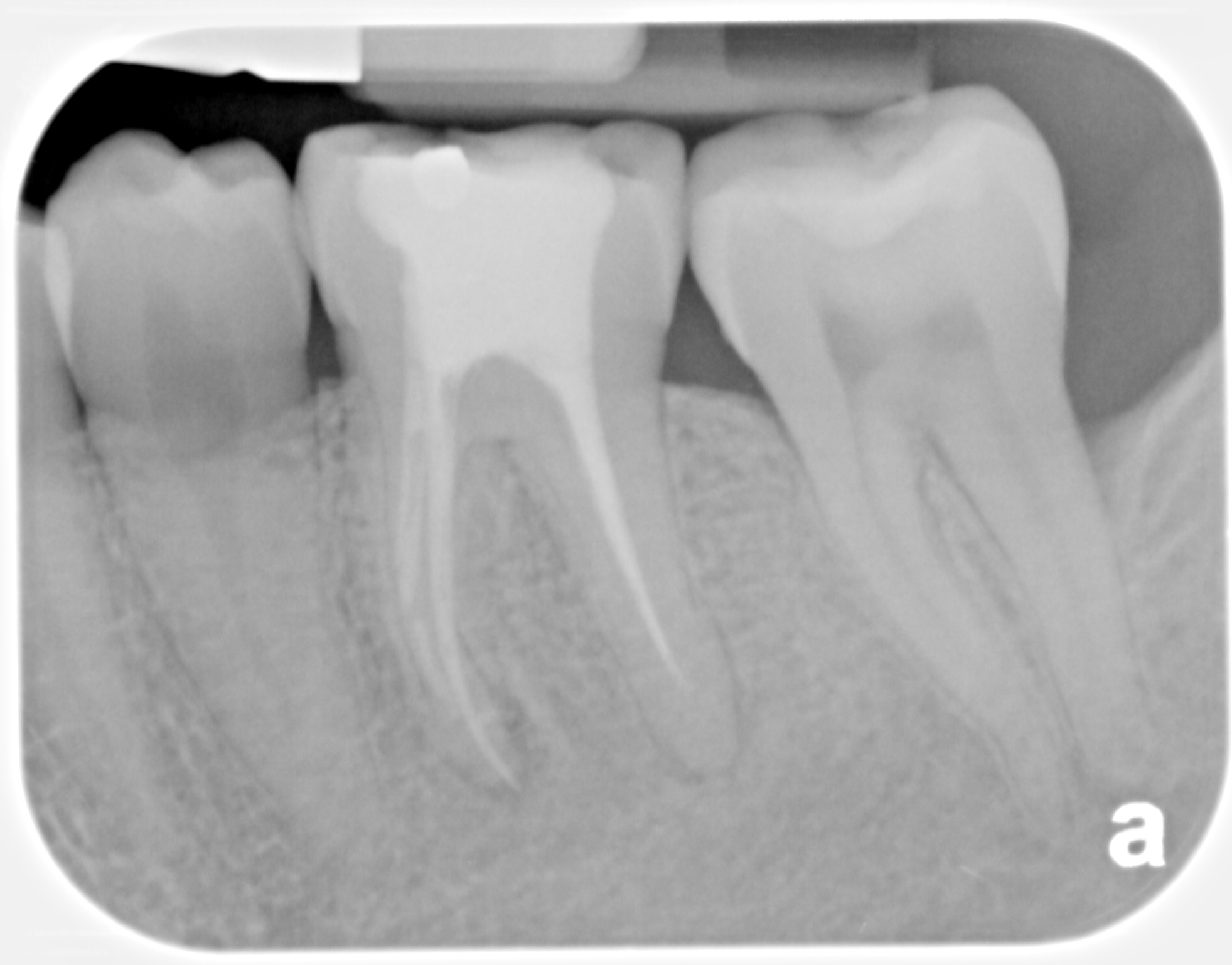 Bone regrowing between roots after LANAP, Laser and cosmetic dentistry in Louisville